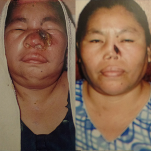 Cancer-InmunoReal-Mexicali-2014