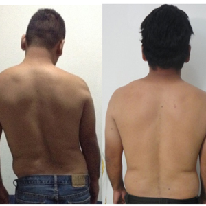 Escoliosis-InmunoReal-Mexicali-2014