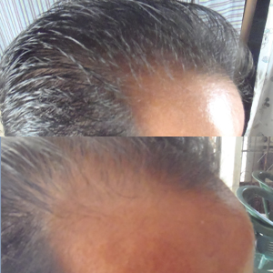 Alopedia-InmunoReal-Mexicali-2014